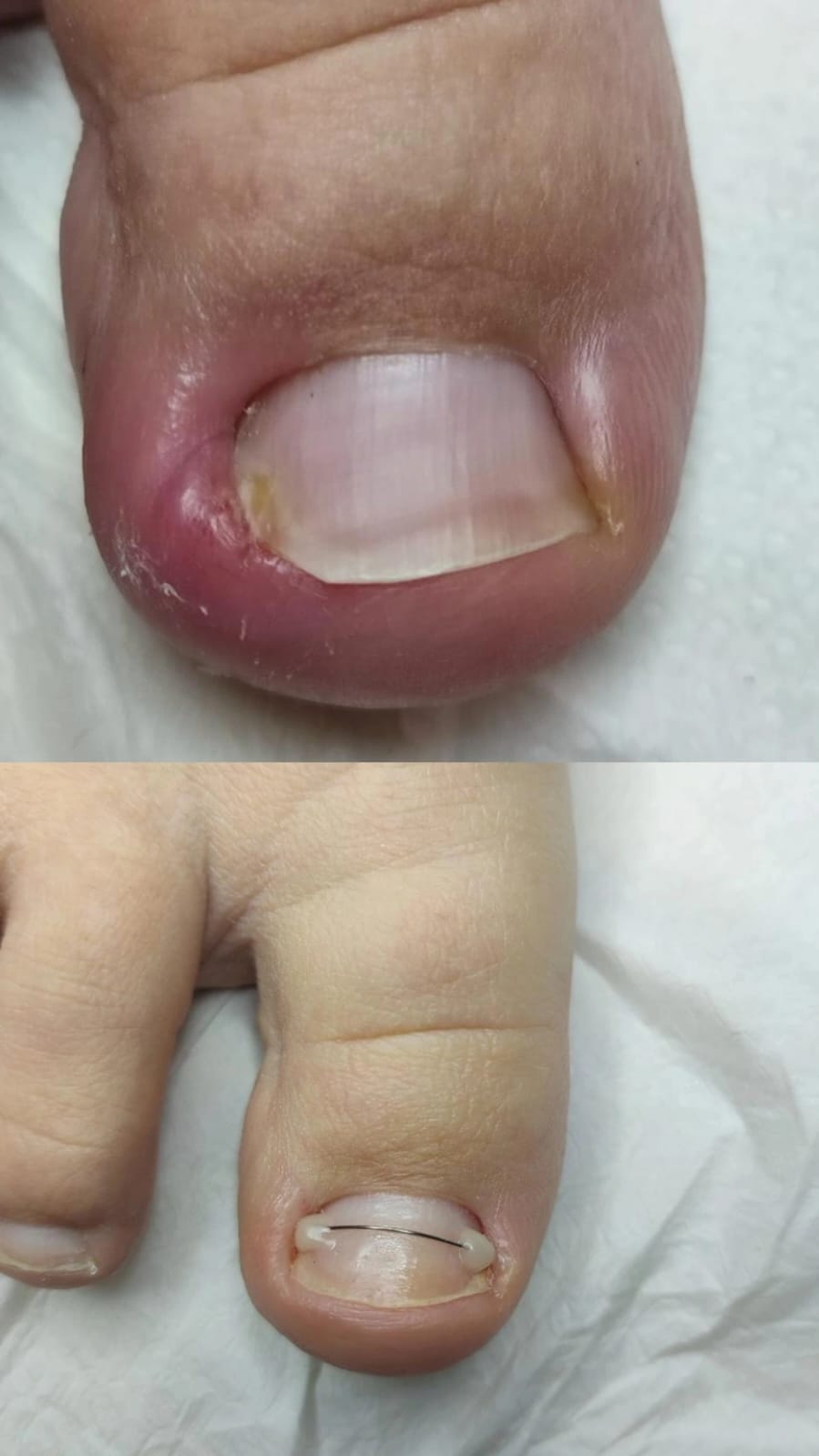 BATIK TIRNAK TEDAVİSİNDE NİCEA PODOLOJİ EKİBİ OLARAK NELER YAPIYORUZ? - Resim 4